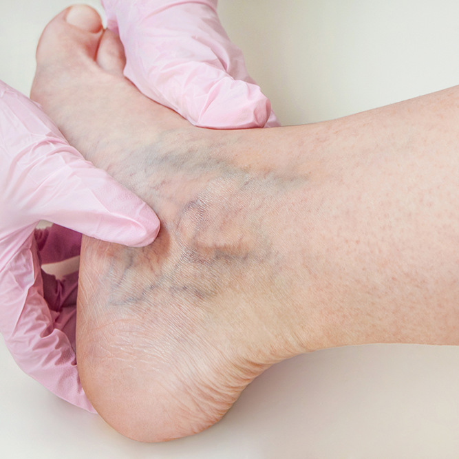 sclerotherapy for spider vein treatment